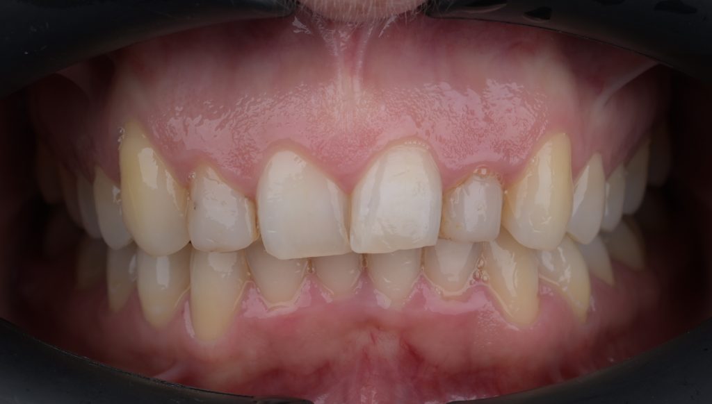Ceramic Veneers before and after