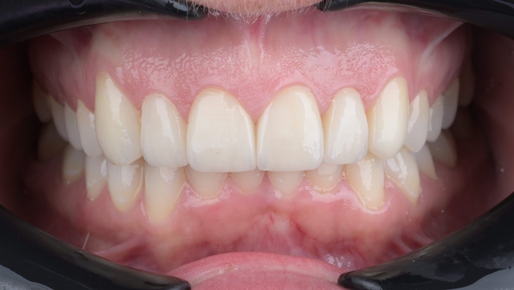 Ceramic Veneers before and after
