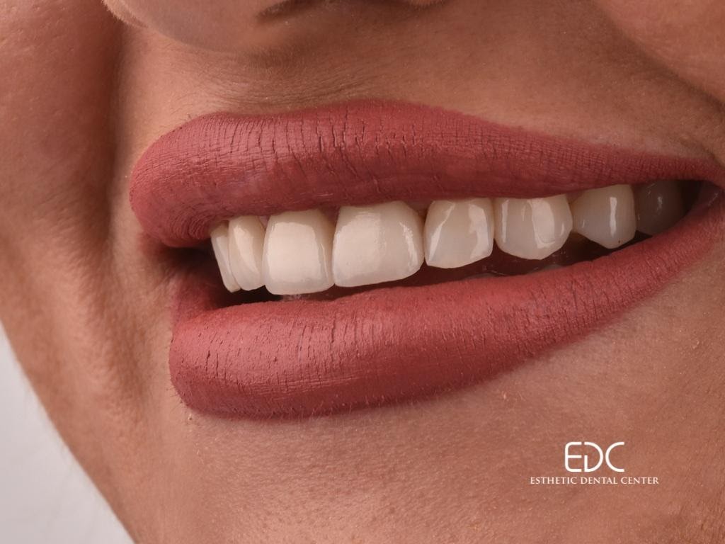 EDC primjer ljuskica za zube - ženski zubi