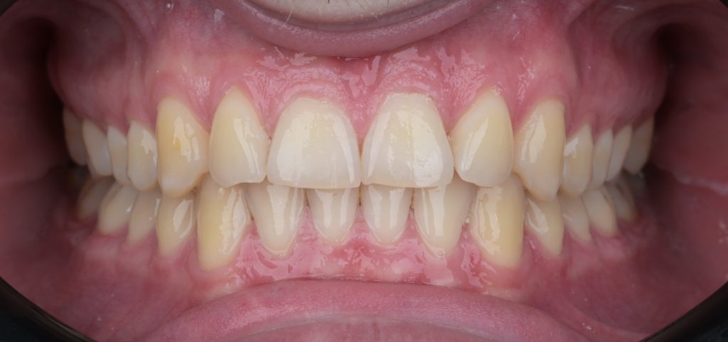 ESTHETIC ORTHO ALIGNER PRIJE I POSLIJE