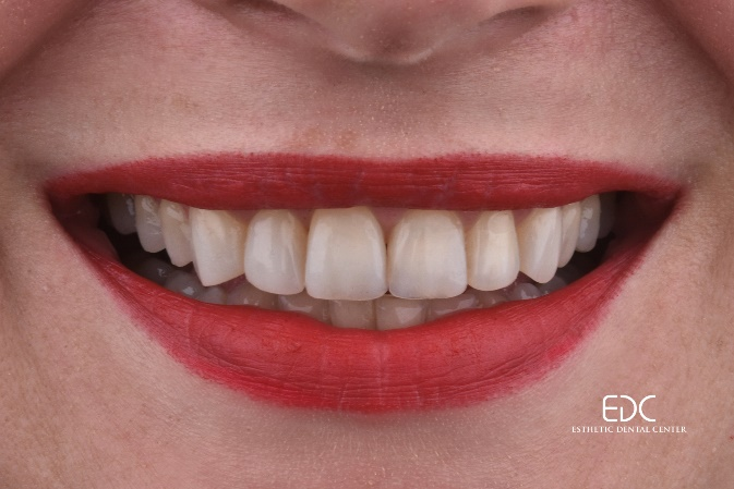 keramicke ljuskice prije i poslije