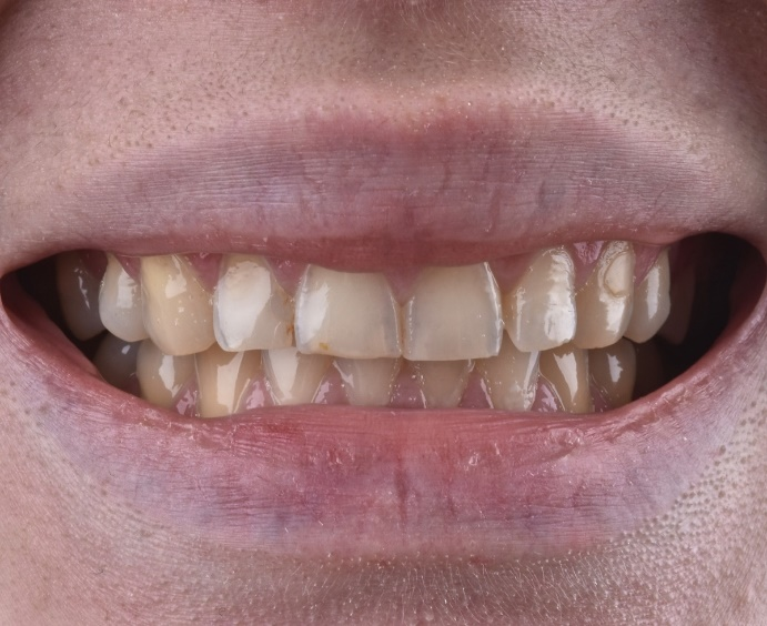 keramicke ljuskice prije i poslije